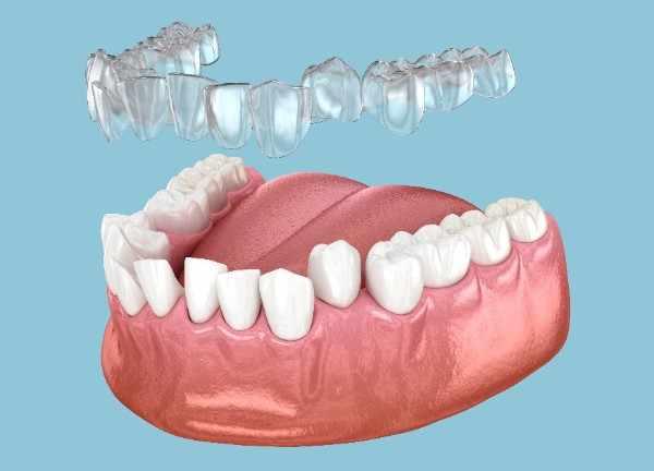Invisalign Cheltenham